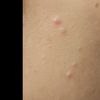 Des boutons sur une partie du visage : la cause ?