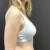 Choix de la taille des prothèses mammaires