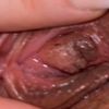 Nymphoplastie J+45 post-op