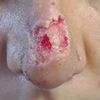 Rhinoplastie ratée par dr Lassaad Gargouri en Tunisie