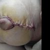 Mastopexie : ma cicatrice me fait peur