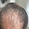 Greffe de cheveux FUE à J14 