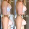 Prothèse droite bloquée depuis le début 