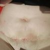 Abdominoplastie ⏱ Février - Mars