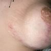 Problème suite à un lifting avec implant mammaire
