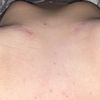 Problème suite à un lifting avec implant mammaire