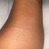 La dermopigmentation pour traiter les cicatrices