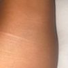 La dermopigmentation pour traiter les cicatrices