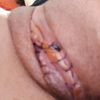 Douleurs atroces après nymphoplastie