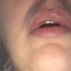 Des oedemes au contour des lèvres - 7147