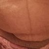 Abdominoplastie sécu