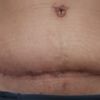 5 mois après abdominoplastie