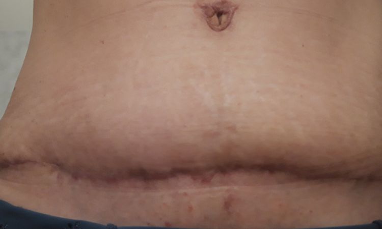 5 mois après abdominoplastie - 7985