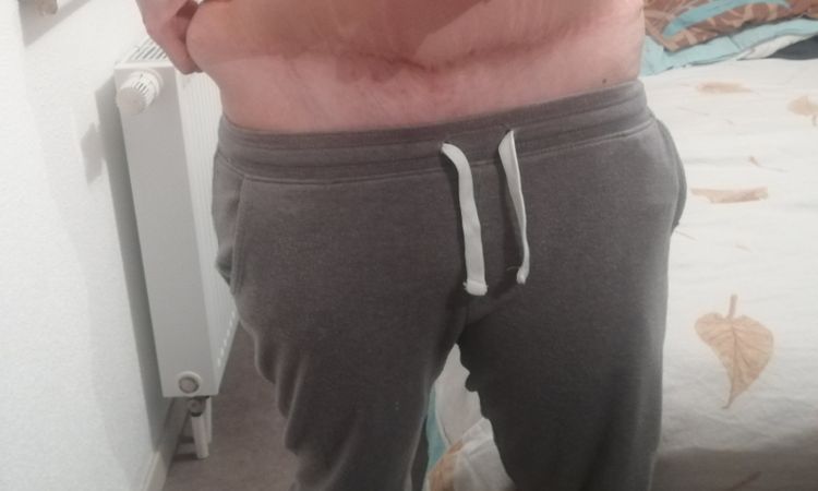Poignet d'amour après une abdominoplastie - 8007