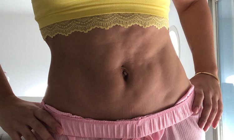Irrégularité après une liposuccion du ventre - 8313