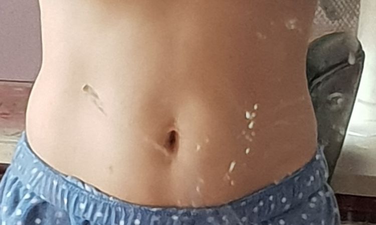 Cryolipolyse ou lipolaser - 8342