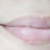 Cicatrice hypertrophique lèvre - 8553