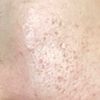 Cicatrices acné joues - 8705