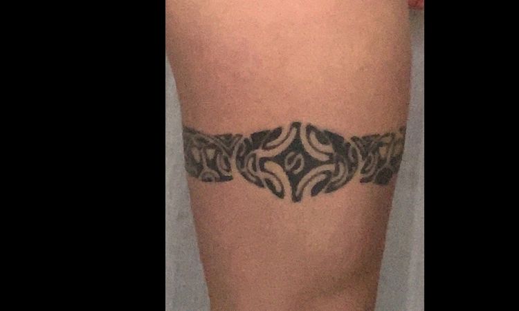 Enlever au laser mon tatouage - 8811