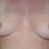 Legere Asymétrie des seins