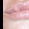 Boule sur la lèvre supérieure - 11961