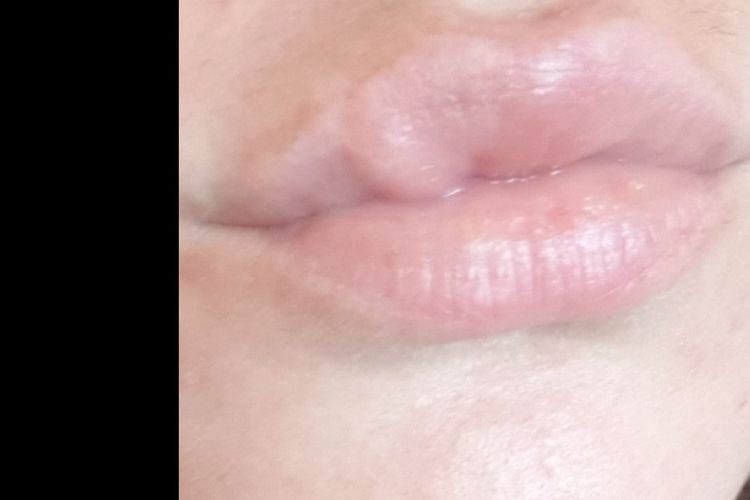 Boule sur la lèvre supérieure - Multiesthetique.fr