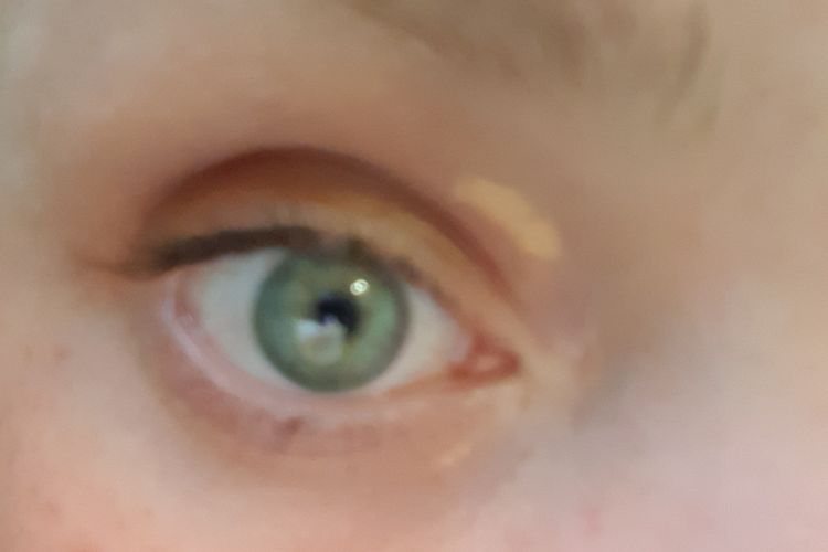 Traitement xanthelasma