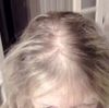 Greffe de cheveux méthode FUE femme 58 ans ?