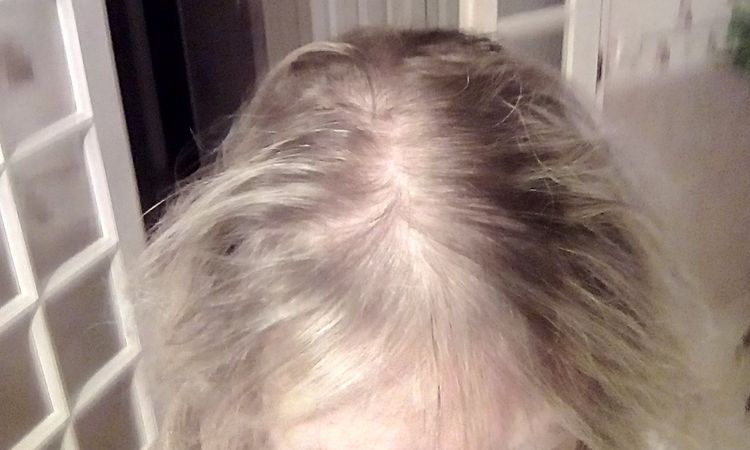 Greffe de cheveux méthode FUE femme 58 ans ? - 12292