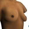 Augmentation ptose mammaire sans cicatrice