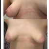 Mes seins sont ils tubéreux ?