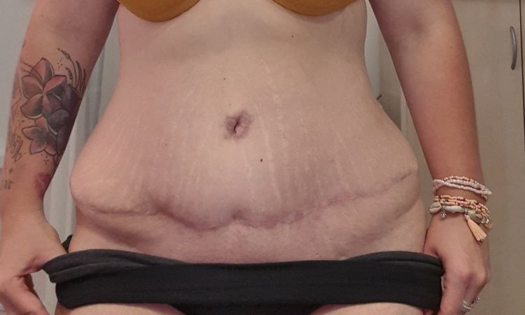 Retouche abdominoplastie - 15023