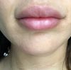 Injections AH lèvres ratées? - 15319