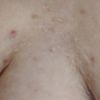 Complexe Cicatrices entre les Seins