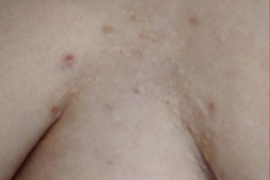 Complexe Cicatrices entre les Seins - 15404