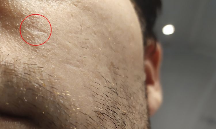 Léger creux dans la peau suite à un peeling superficiel - 15719