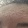 Au secour... poussée d’acné après une séance de laser PICOPLUS - 16211