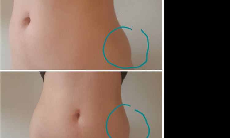 Asymétrie suite Liposuccion - 16538
