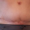 Résultat abdominoplastie après 18 mois