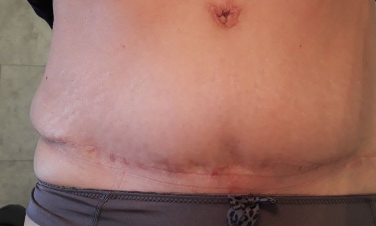 Résultat abdominoplastie après 18 mois - 16572