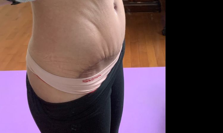 Pli après abdominoplastie - 16663
