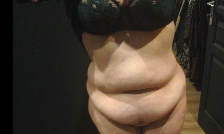 Abdominoplastie sans perte de poids préalable - 16727