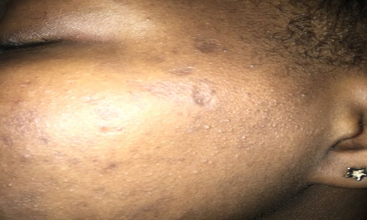 Trou au visage et tache et tache au jambes - 25127