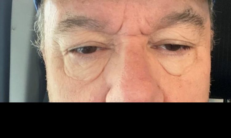 Blepharoplastie avis demandés suite à un mauvais drainage  lymphatique - 25234