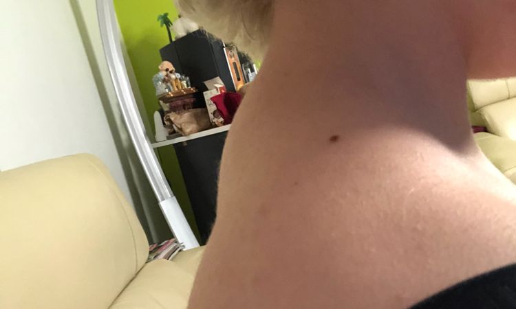 possibilité d'une chirurgie des épaules ? - 32821