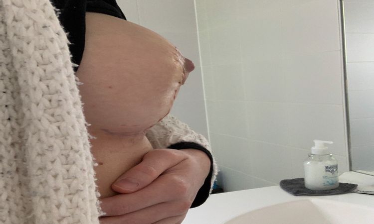 Sein difforme après mastopexie - 33050