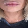 Lèvres gonflées, apparence bec de lièvre après injections AH