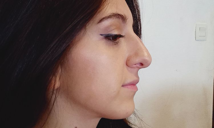 Rhinoplastie medicale Possible ? - 33216