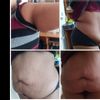 Abdominoplastie à 23 mois de la sleeve