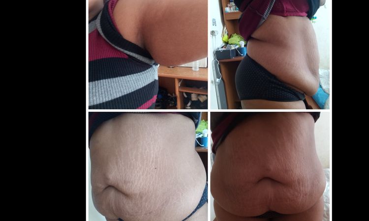 Abdominoplastie à 23 mois de la sleeve - 33313